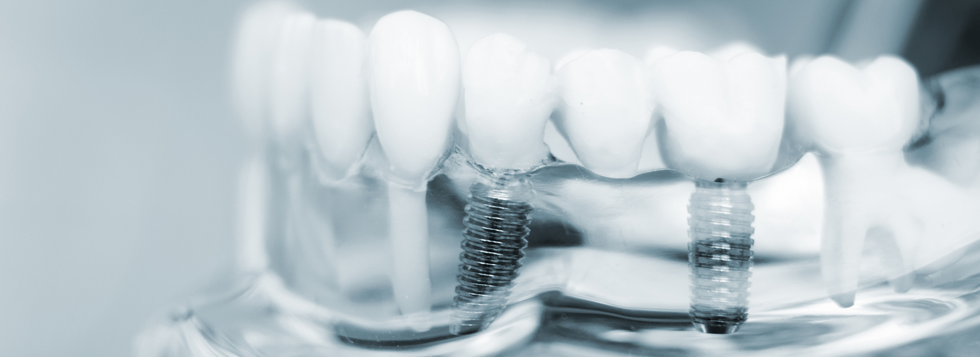 The image shows a close-up of multiple dental implants, with each implant featuring a visible screw and a clear plastic crown.