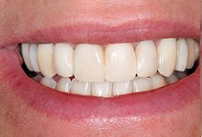 The image shows a close-up of a person s teeth, with the individual smiling broadly.
