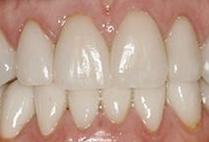 The image shows a close-up of someone s teeth, with the focus on the lower front teeth which appear to be discolored or stained.