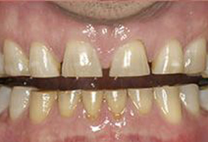The image shows a close-up of a person s teeth with visible staining and discoloration, particularly in the front teeth.